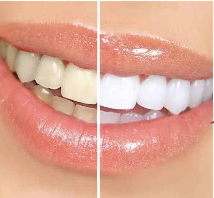 Teeth Whitening