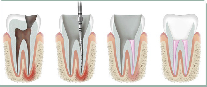 Root Canal Treatment