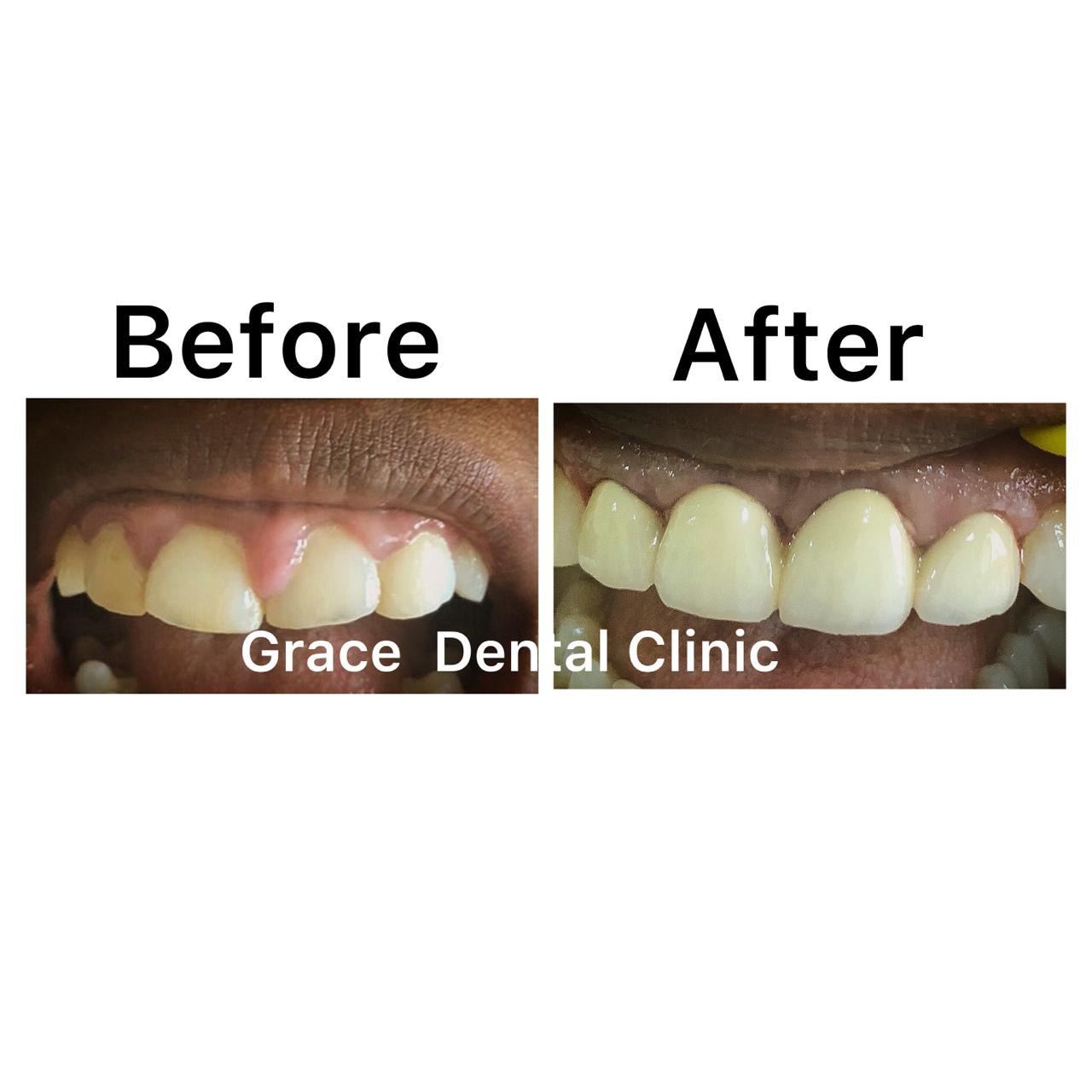 Gum Treatment